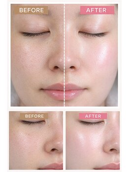 クリスタル(Crystal)/顔脱毛＋美容成分たっぷり