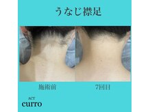 アクト クロ(ACT curro)/【うなじ襟足】脱毛施術例