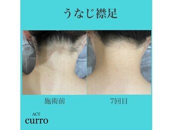 アクト クロ(ACT curro)/【うなじ襟足】脱毛施術例