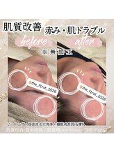 ケア ラウンジ ザ ファースト(THE F1RST)/肌質改善＊ビフォーアフター