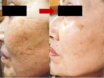 ブリリアン デイスパ 阪急西宮ガーデンズ店(BRILLIAN DAYSPA)/水光ピーリング