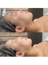 カンナムビューティー/オンダリフト/表参道/ララピール