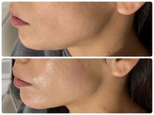 エフェクト 塚口店(effect)/Before After &nbsp;&nbsp;40代/1回目