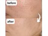 【9/30迄/初回限定】肌の凹凸・ざらつきを根本改善へ★¥50,000→¥35,000