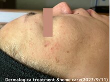 オアシスラグーン(OASIS LAGOON)/シミケア（症例６：after）