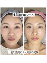 セリア(CELIA)/小顔矯正　