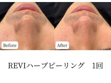 マテオ(Matteo)/ハ-ブピ-リング1回でこの効果