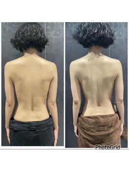 エステサロンブランシュ(Esthe salon Blanche)/ハーブピーリングで背中ケア