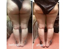 ヤン リン 整体(Yang Ling 整体)/セル脂肪撃退！