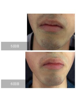 ダンニヒル(dannihil)/【ヒゲ脱毛】20代学生6回目