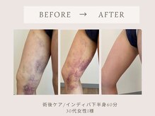 フェリチタトウキョウ(Felicita Tokyo)/術後ケア_インディバ60分