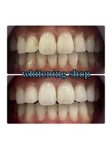 ホワイトニングショップ 大阪玉造店/Before&After美白ホワイトニング