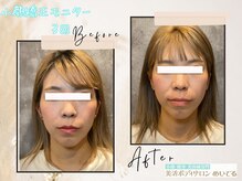 めいてる/【小顔矯正】３回の変化