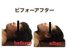 ミクロスポーツ整骨院(MICRO SPORTS整骨院)/【befor/after】40代〔たるみ〕