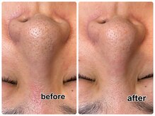 30代女性♪美容液でお肌を洗浄♪サロン技術でつるんっ！