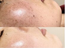 アナパ・オラ/ハーブトリートメント（2.5g）