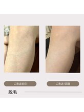 レイール(Reir)/脱毛効果　before→after