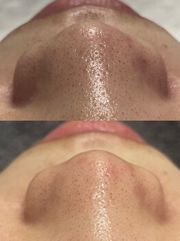 アットウィル 志木店(at will)/毛穴洗浄BeforeAfter