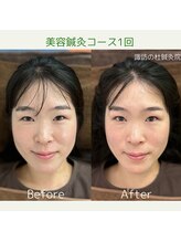 諏訪の杜鍼灸院/美容鍼