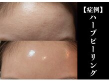 The水光美肌専科/ハーブピーリング×幹細胞