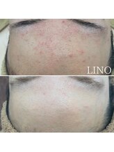 リノ(Lino)/vosサロンケア
