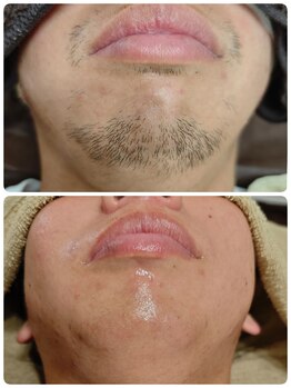 アルマサロン 菊陽(Almasalon)/ヒゲワックス脱毛☆