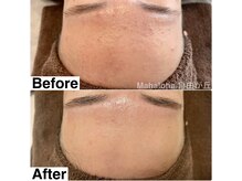 マハロハ 自由が丘(Mahaloha)/【額のザラつき・肌荒れ改善】