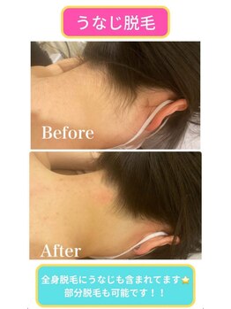 モット 神戸店(Motto)/全身脱毛