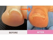 よつば整体院/低刺激巻き爪ケア