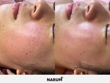 ナルムフェイシャル 代々木(NARUM facial)/白玉ピーリング