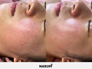ナルムフェイシャル 代々木(NARUM facial)/白玉ピーリング