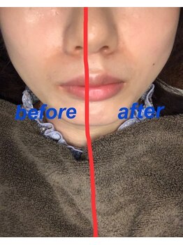 ロミハリ(LomiHari)/美容鍼施術後