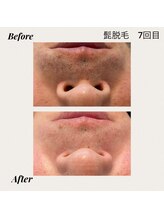 ジン フォー ユアビューティー(JIN for your beauty)/施術経過