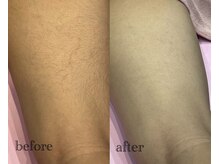 Before自己処理で毛穴ポツポツ…Afterつるんと美脚自己処理×