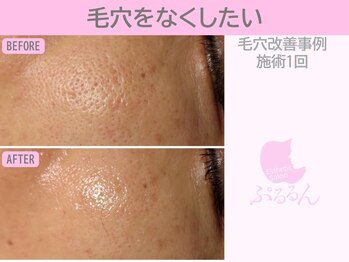 ぷるるんエステ/毛穴/小顔/フェイシャル