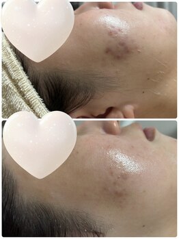 リクラ 北千住(Reclat)/ララピール2回ビフォーアフター