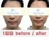 【悩んだらこれ！】本格派の小顔矯正 エラ張り/左右差/むくみ