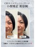 【2回目以降の方】ホッチキス美容鍼＋鎖骨お顔周りリンパ＋小顔矯正
