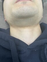 ナノハナ/鹿沼市の全身脱毛のナノハナ