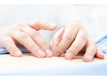 スクナビコナ鍼灸院/鍼を打つ様子