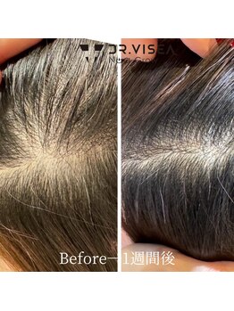 リジューブ(Rejuve)/