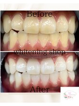 ホワイトニングショップ 本厚木店/【ビフォーアフター】3回目