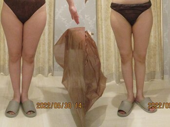 プロラボスパ 岡山店/30代前半　症例写真