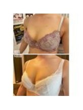 美人バスト 表参道店/20代◇バストアップ症例/育乳