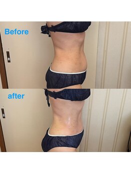 クレマチス/ハイパーナイフEX2