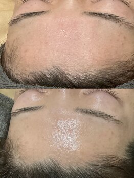 スイ メゾン アトリエ(SUE Maison Atelier)/ハーブピーリング