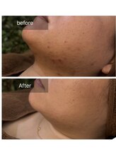 ビビ(VIVI)/お顔のニキビ・赤みに