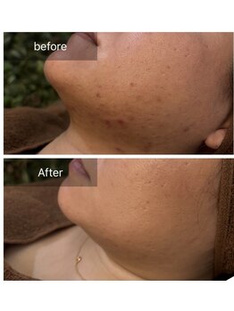 ビビ(VIVI)/お顔のニキビ・赤みに