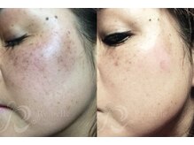 エルビービュティーサロン(LB BEAUTY SALON)/【ニキビ改善】ハーブピーリング