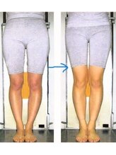 かんだ接骨院/O脚・X脚矯正